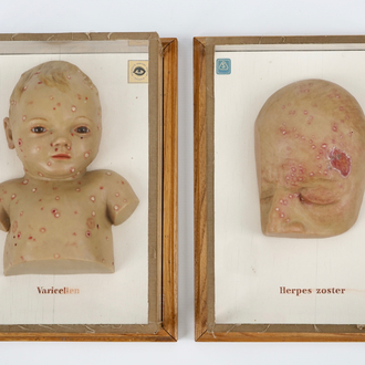 Twee wassen doktersmodellen van kinderziektes, Duitsland, midden 20e eeuw