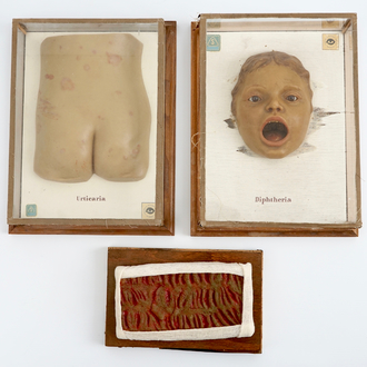 Drie wassen doktersmodellen van kinderziektes, Duitsland, midden 20e eeuw