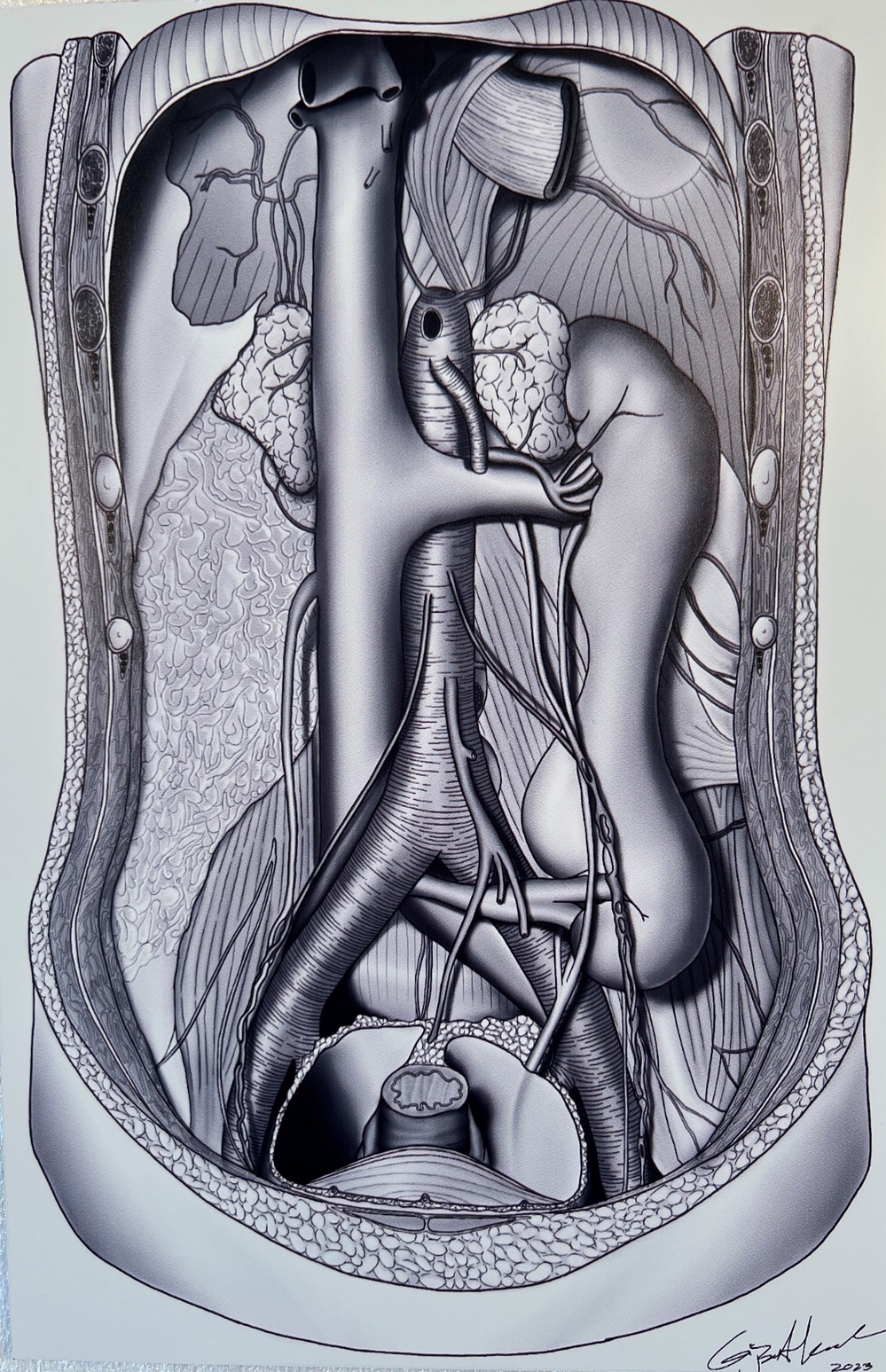 Gijs van Alkemade: 'Crossed Renal Ectopia with Fusion Anomaly', digital pen, mounted in alucobond, 2023