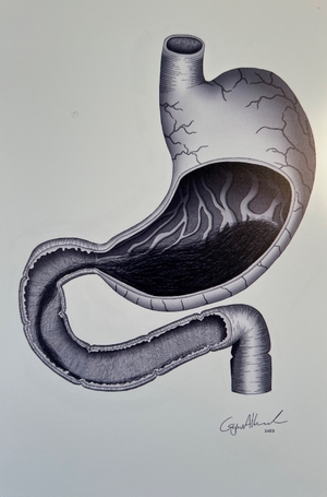 Gijs van Alkemade: 'Trichobezoar with Rapunzel syndrome', digital pen, mounted in alucobond, 2023