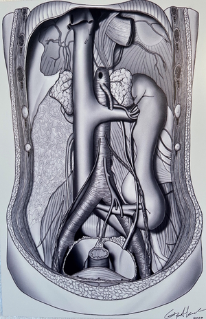 Gijs van Alkemade: 'Crossed Renal Ectopia with Fusion Anomaly', digital pen, mounted in alucobond, 2023